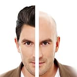 hair loss in a man
