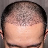 hair loss