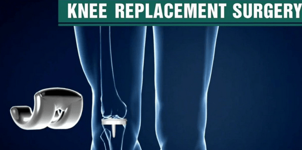 Tips for Choosing the Right Knee Replacement Surgeon