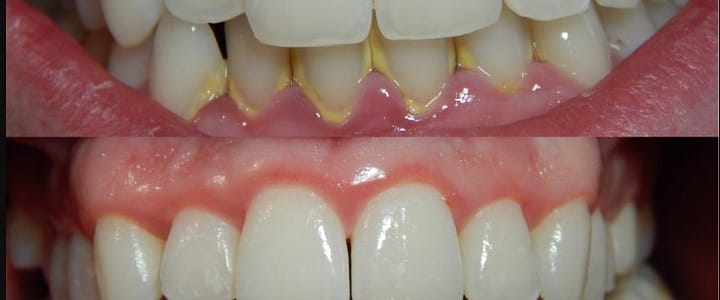 cleaner teeth