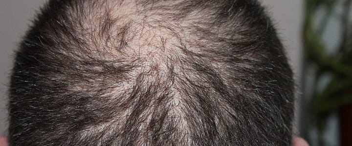 hair loss